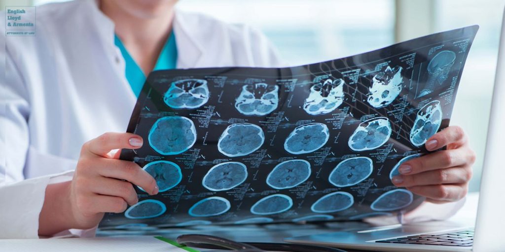 Yucca Valley Brain Injury Lawyer